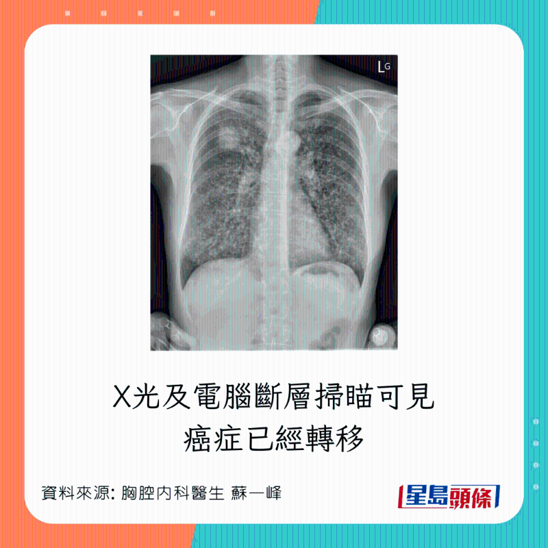 胸腔内科医生苏一峰分享肺癌病人情况