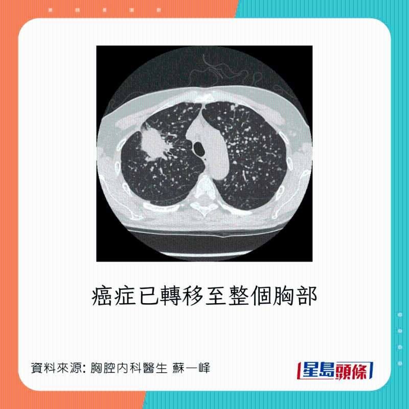 胸腔內科醫生蘇一峰分享肺癌病人情況