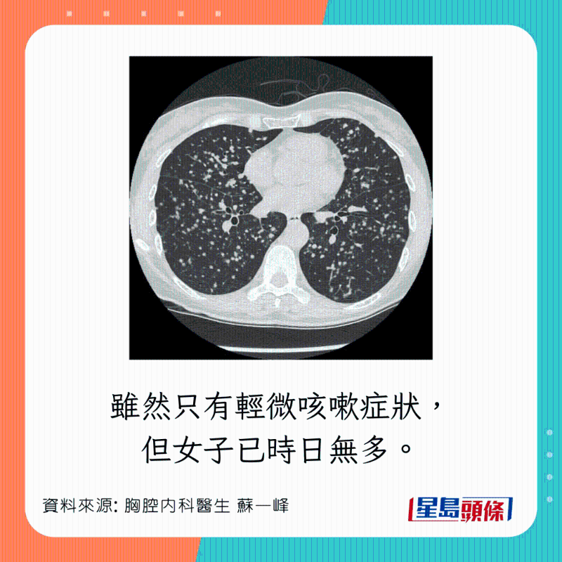 胸腔內科醫生蘇一峰分享肺癌病人情況