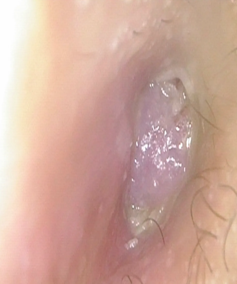患者外耳道充滿粉紅色肉芽組織。
