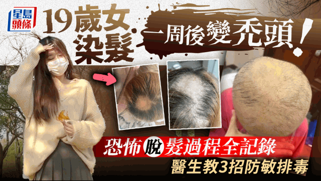 9岁女染发一周后脱发，毛囊坏死恐一世秃头