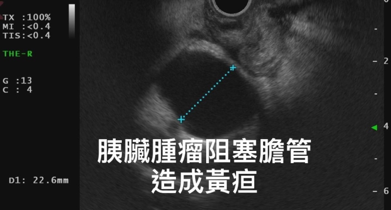 林相宏医生为男子进行超声波检查（图片获胃肠肝胆科医生林相宏授权转载）