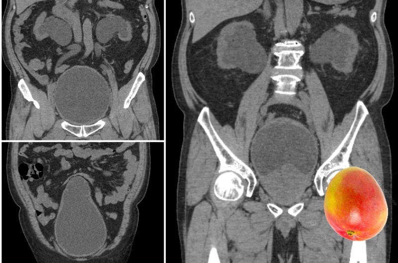 该患者前列腺肥大，肿大如芒果