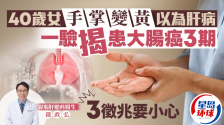 40岁女手掌变黄以为肝病，一验揭患大肠癌3期，3征兆要小心